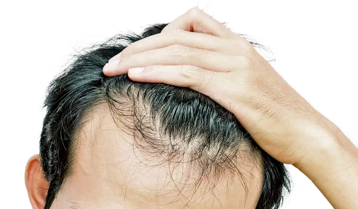 علاج تساقط الشعر